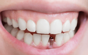 a person smiling with a dental implant in their mouth