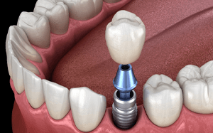 computer illustration of an implant crown