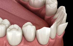 Illustration of crooked teeth