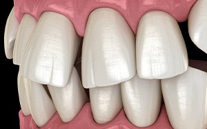 Illustration of gapped teeth