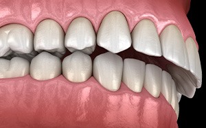 Illustration of an overbite