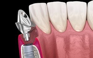 A 3D illustration of a placed dental implant and its abutment