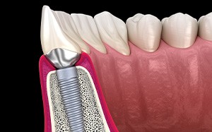 A 3D illustration of a dental implant with its final restoration