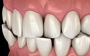 Illustration of a crossbite