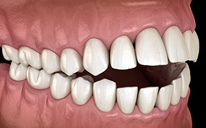 Illustration of an open bite