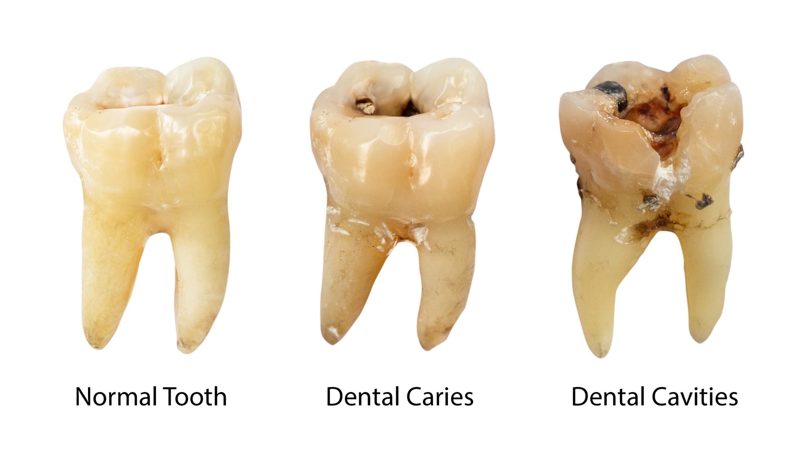 Cavity 2 Annigan Dental